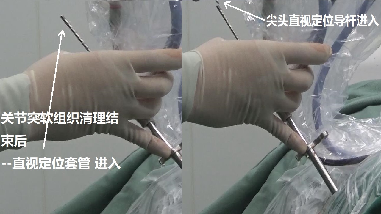 11-直视定位导杆进入到关节突.jpg